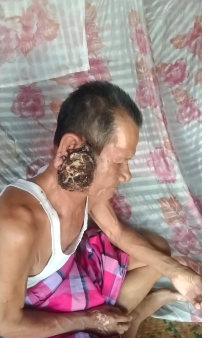 
					Karim warga tiyuh penumangan penderita Tumor ganas tak mampu berobat luput dari Q sehat tubaba